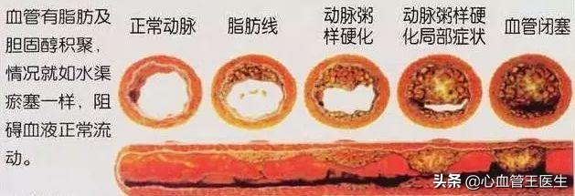擔(dān)心：心血管狹窄導(dǎo)致心梗，夜不能寐！醫(yī)生解釋完，放心了