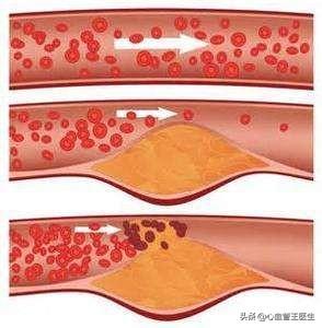 擔(dān)心：心血管狹窄導(dǎo)致心梗，夜不能寐！醫(yī)生解釋完，放心了