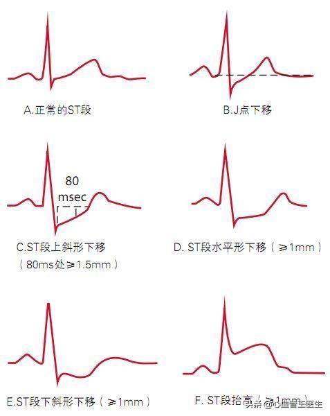 20歲女生心電圖提示心肌缺血！這可怎么辦？醫(yī)生看完她放心了