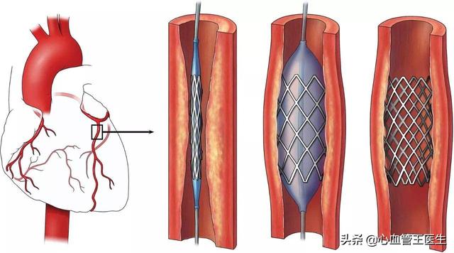 王药师放了心脏支架，2年后支架又堵了！医生找到了根源