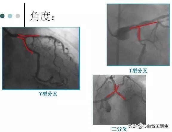 56歲心臟病患者，要求復(fù)查造影，醫(yī)生講完造影的危害，馬上拒絕！