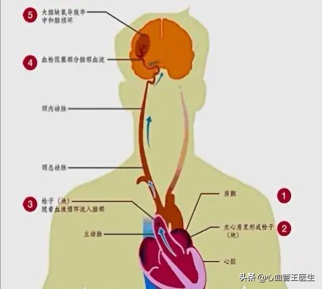 我国脑梗死是心肌梗死人数的8倍，可是国外是1：1，原因在此！