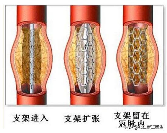 心脏支架后如何快速恢复？能不能活动？心血管专家明确回答！