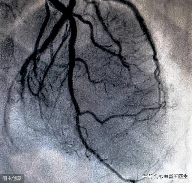 冠心病、心肌缺血、心绞痛、心肌梗死别再傻傻分不清！一次讲明白