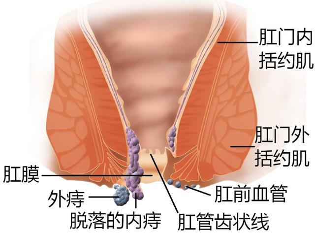 我好像得了痔疮，怎么办，在线等，急急急！