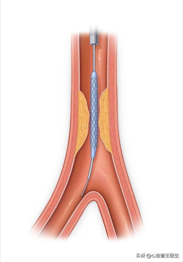同是心脏支架，可是为什么进口支架比国产支架贵那么多？如何选择