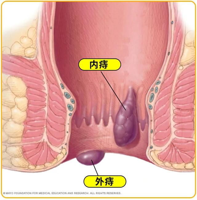 “菊”部警告！很多人因此饱受折磨痛到炸裂！