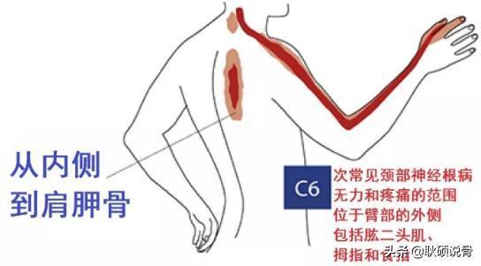 「上肢过电感，有时手麻，」警惕颈椎病