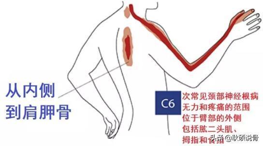 「上肢過(guò)電感，有時(shí)手麻，」警惕頸椎病