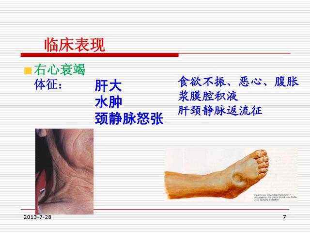 腿肿，一按一个坑，是什么病？医生告诉您：常见的就是心肾衰竭