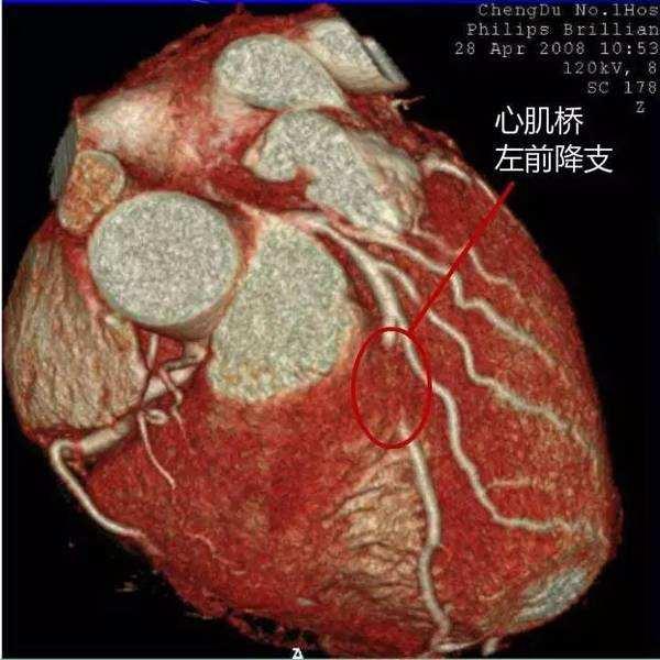 最新研究，有心肌桥的人比没有心肌桥的人，发生心梗风险高3倍