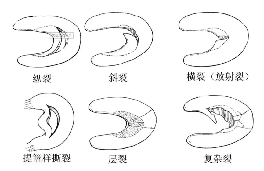 不得不说,现在已经有很多方法可以进行治疗:保守治疗,半月板缝合修补