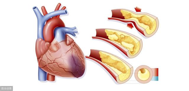 中国专家最新血脂管理建议：低密度脂蛋白这水平才能预防冠心病