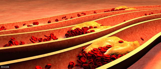 中國(guó)專家最新血脂管理建議：低密度脂蛋白這水平才能預(yù)防冠心病
