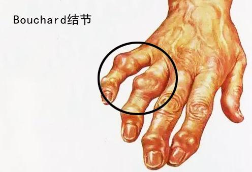 手指發(fā)生這種改變意味著可能患有骨關(guān)節(jié)炎，醫(yī)生教您如何自檢