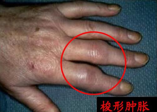 手指发生这种改变意味着可能患有骨关节炎，医生教您如何自检