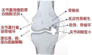 骨质增生太难治愈？骨科医生：这4件事，坚持做好，关节少遭罪！