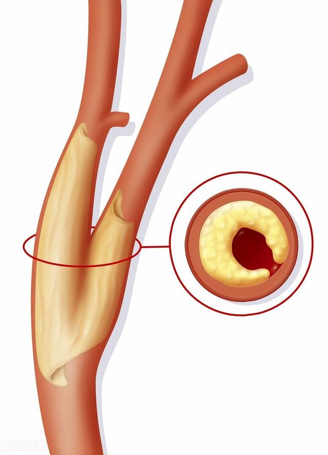 3个人就有1个颈动脉斑块！如何预防和治疗？医生说的清清楚楚