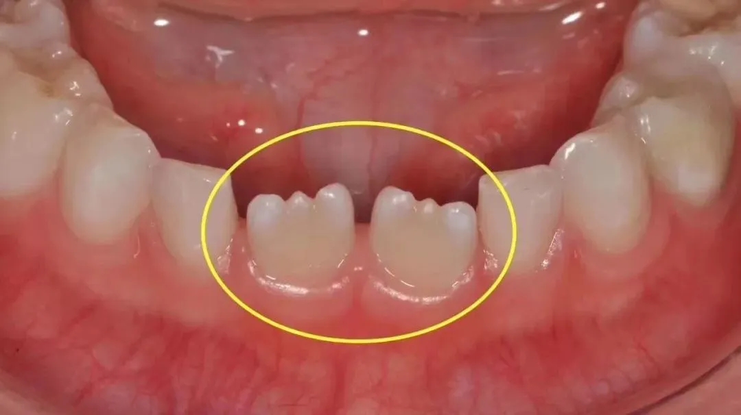 发育叶融合形成,融合不完全的部分就形成了锯齿,常见于上下前门牙及侧