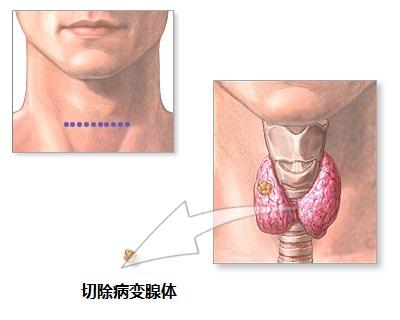 甲状旁腺和甲状腺是一回事吗？协和专家提醒：甲状旁腺是人体不可忽视的腺体