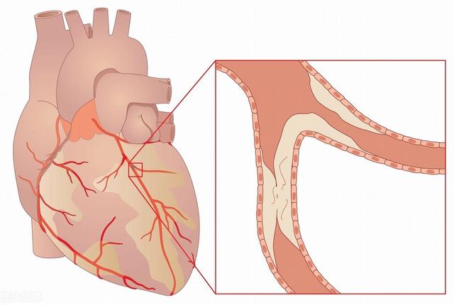4個(gè)方法診斷冠心病心肌缺血，4個(gè)方法來(lái)治療！醫(yī)生說(shuō)的清清楚楚