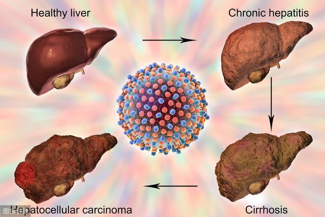 肝癌为何被称为癌症之王？医生：你需要了解的防治方法，都在这里