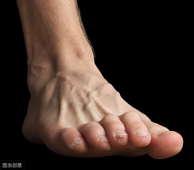 糖尿病足是什么病？醫(yī)生：你需要了解的防治方法，都在這里
