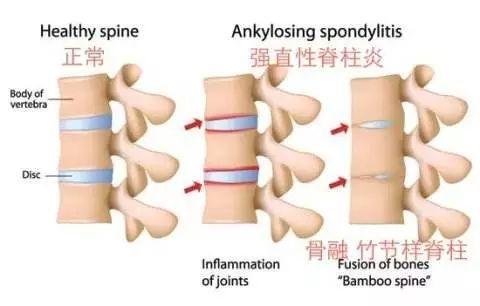 困擾周杰倫的強(qiáng)直性脊柱炎，到底是什么??？骨科醫(yī)生專業(yè)角度分析