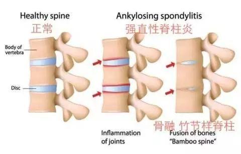 困擾周杰倫的強直性脊柱炎，到底是什么??？骨科醫(yī)生專業(yè)角度分析