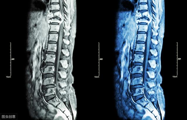 困擾周杰倫的強直性脊柱炎，到底是什么??？骨科醫(yī)生專業(yè)角度分析