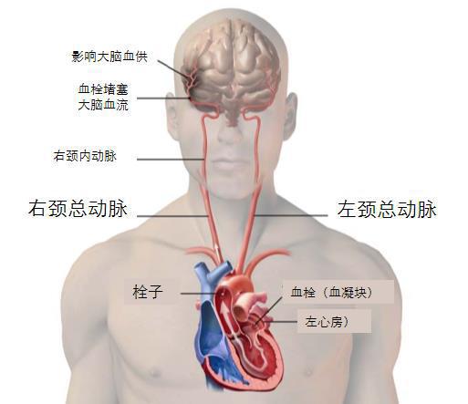 庞老师因高血压导致心跳乱，又因心跳乱导致脑中风，看详细报道