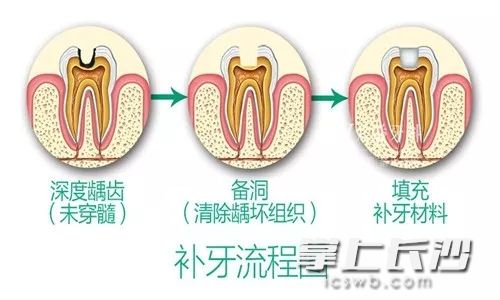 说真的每颗牙都是金钱，看牙不趁早，越拖越贵还遭罪