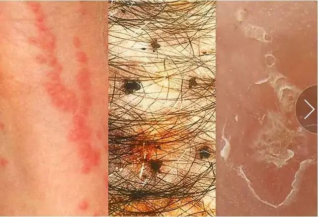 ▼(虫咬性皮炎症状)虫咬性皮炎是指被蚊蠓等虫子叮咬后,皮肤接触其