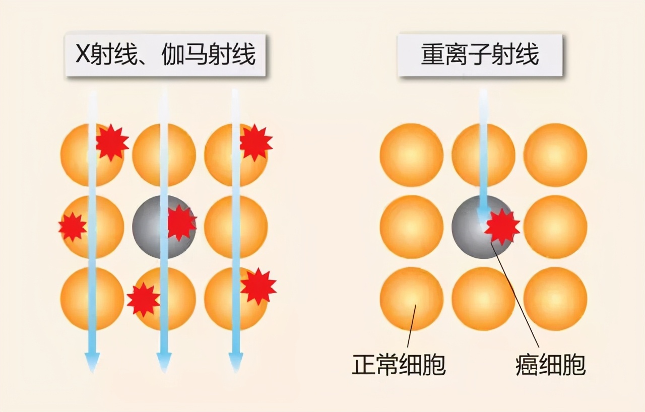 首台国产重离子治疗系统启用，肿瘤“定向爆破术”的能与不能