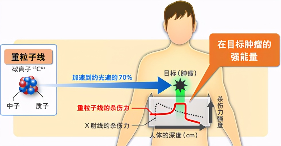 首台国产重离子治疗系统启用，肿瘤“定向爆破术”的能与不能