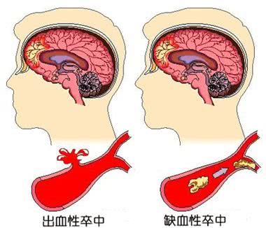 脑卒中,怎么念?怎么防?怎么判断?你可能一样都没搞清楚