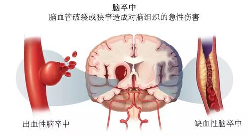 脑卒中，怎么念？怎么防？怎么判断？你可能一样都没搞清楚