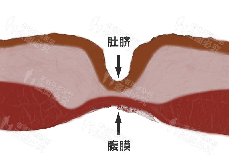 抠完肚脐眼为什么肚子会痛？