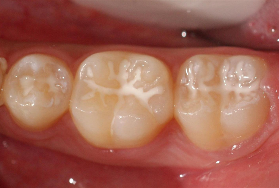 是指不去除牙体组织,在19面,颊面或舌面的点隙裂沟涂布一层粘结性