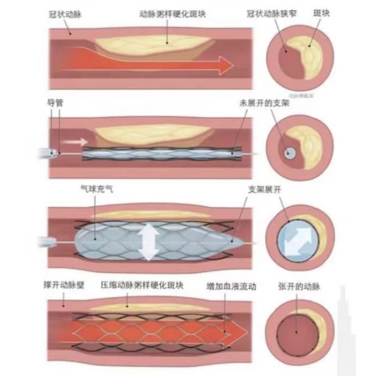 装了支架是不是