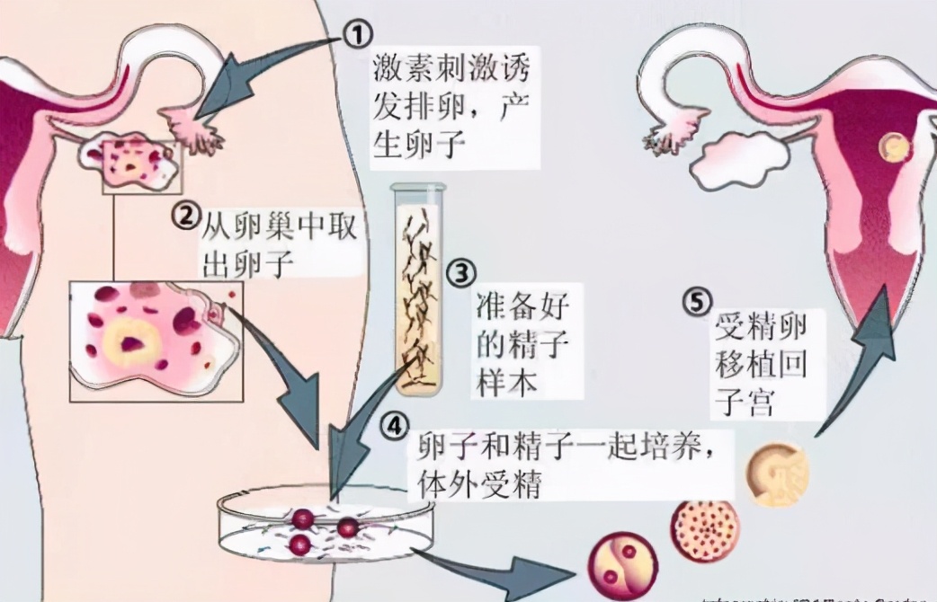 症患者夫妇的精子和卵子取出体外,在体外培养系统中进行受精,形成胚胎