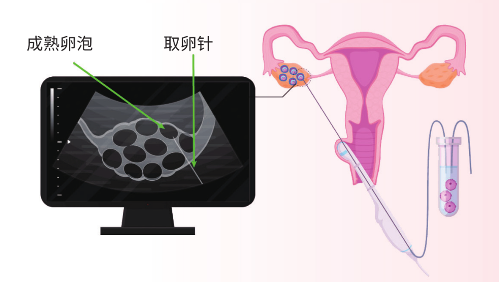 代孕母亲经历了什么？