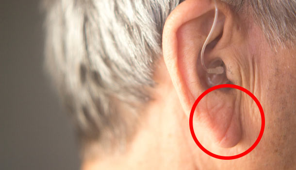 从耳朵皱褶就能提前预知冠心病？别给现象强搭因果