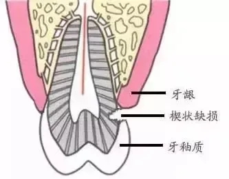 楔状缺损备洞形图解图片