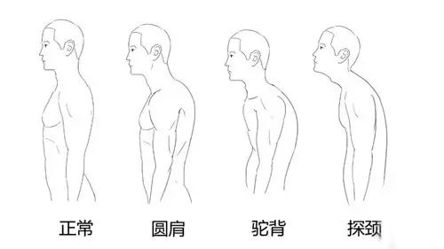 上交叉综合征 (2).jpg