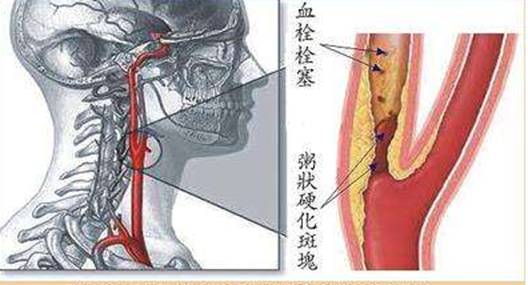 颈动脉斑块是如何危害我们生命的？应该怎样应对