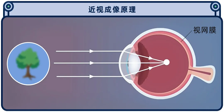 被吹上天的近视手术，为什么很多眼科医生自己都不做？