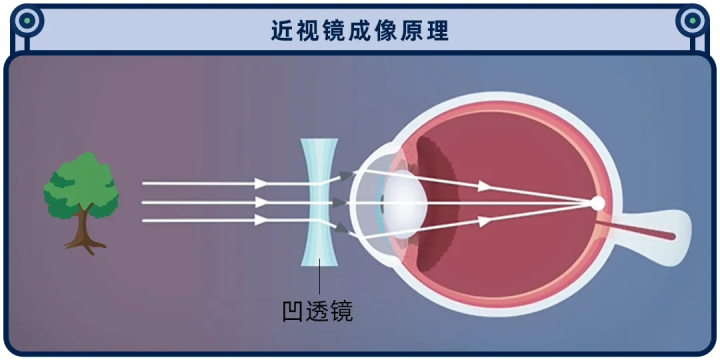 被吹上天的近视手术，为什么很多眼科医生自己都不做？