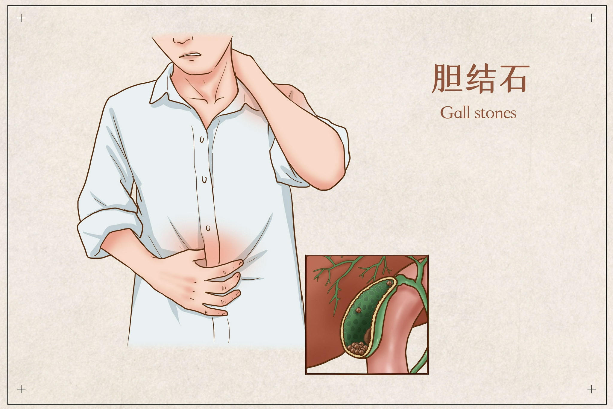 复旦大学附属浦东医院王晓亮:胆石症的个体化治疗