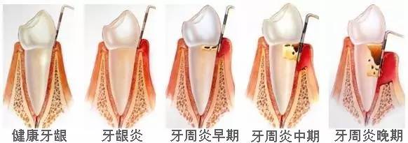 不能洗牙的日子…我聽說紅糖水能去除牙垢？